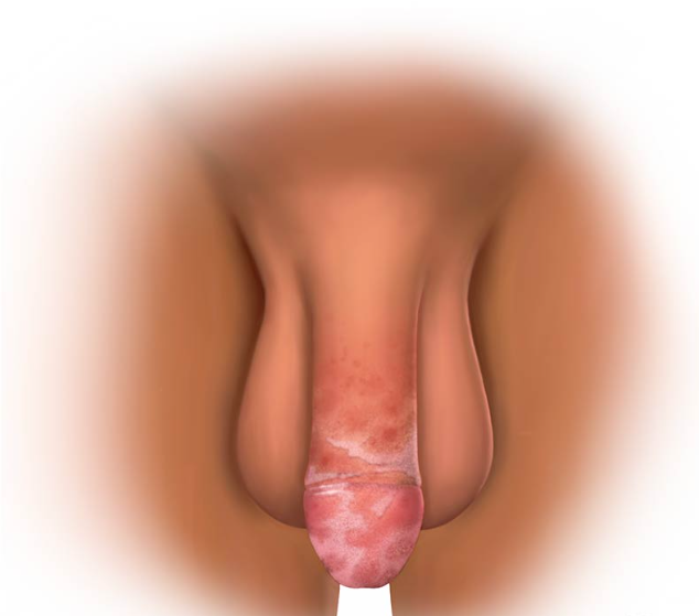 下面瘙痒、刺痛、有异味？很多男性以为是“小问题”，其实可能是感染信号