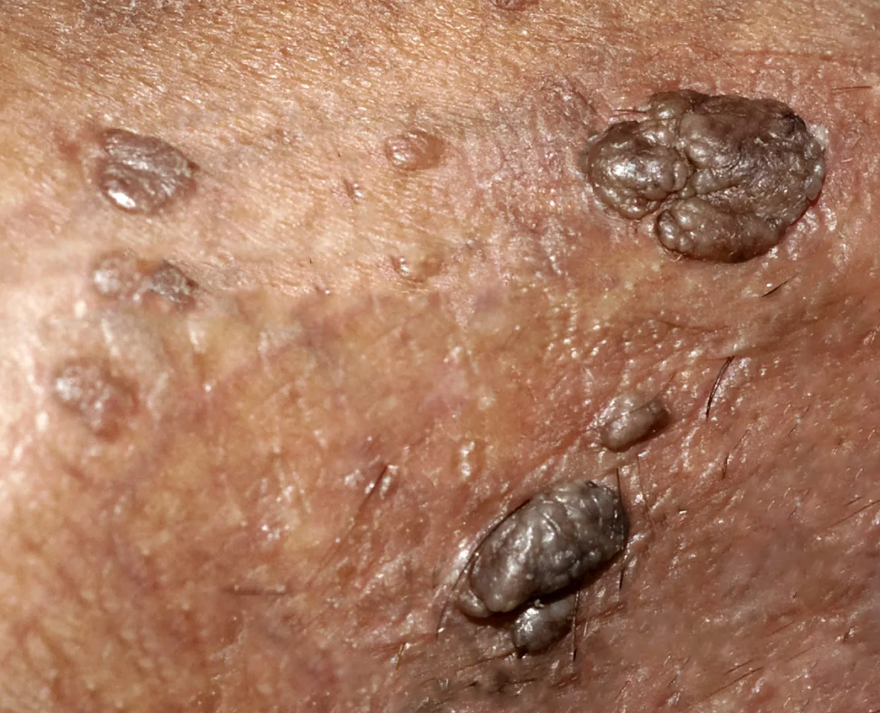 私处突然长出“小疙瘩”，不痛不痒，要紧吗？南阳不少男性拖到后期才重视