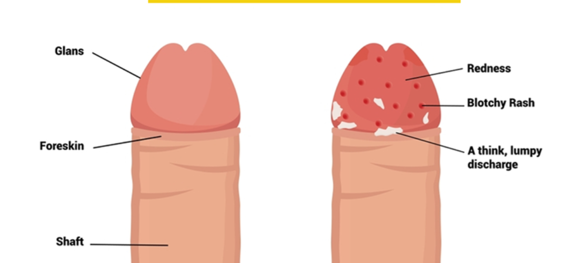 龟头出现红点、瘙痒、刺痛，是性病吗？很多南阳男性第一反应都错了
