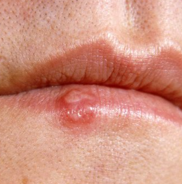嘴上起病毒水泡，致死引热议；丁丁上起小疙瘩，更不能忽视