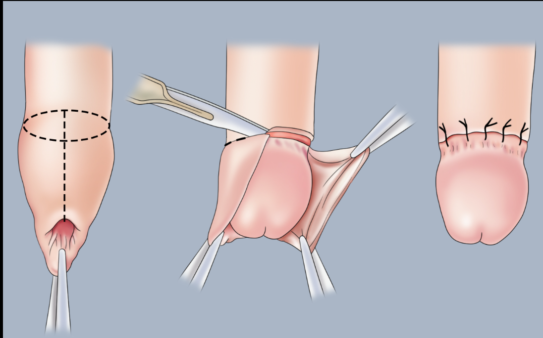 包皮过长一定要割吗？很多男人其实一直搞错了