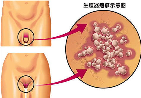丁丁上长小水泡，是普通炎症还是生殖器疱疹？很多男性一开始都没当回事