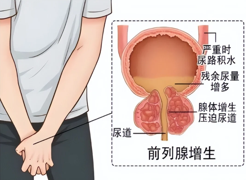 很多男人都有的“前列腺问题”，为什么总是反反复复？医生说出3个常见原因