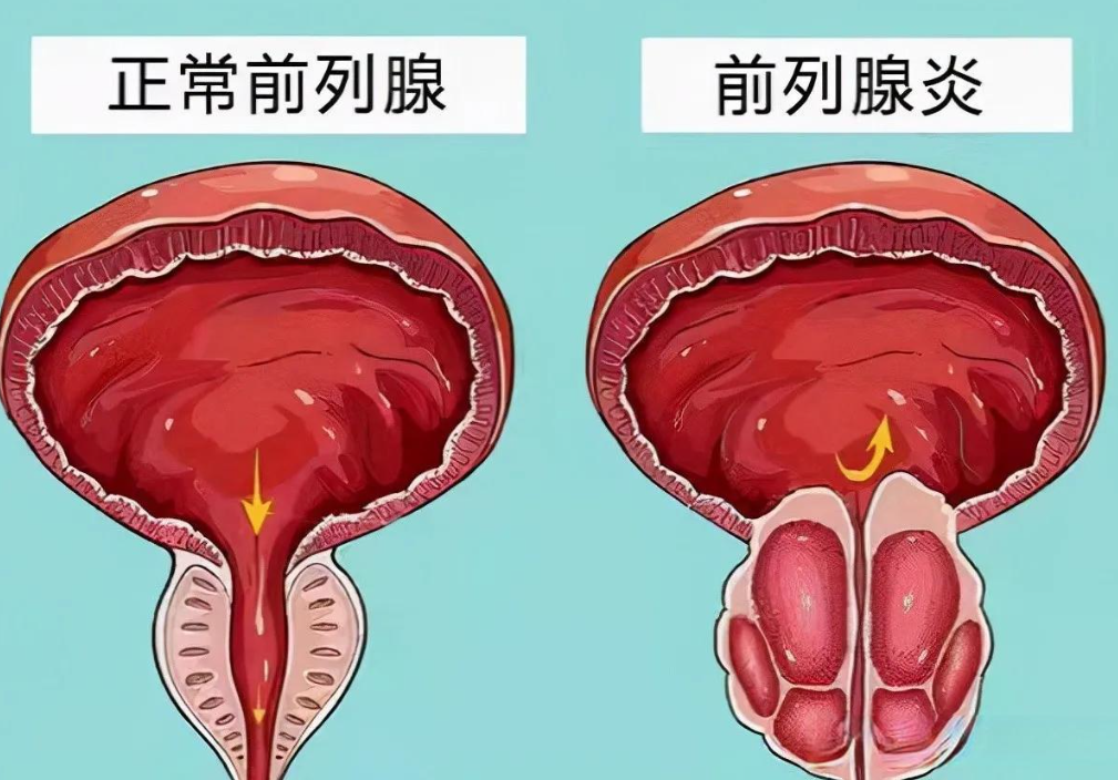 前列腺炎会不会影响性功能？很多男人其实忽略了这个关联